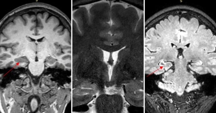 Convulsão durante a menstruação: médicos suspeitam de endometriose cerebral