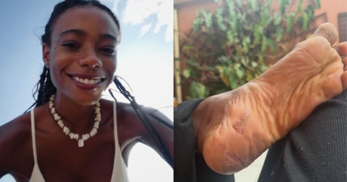 Modelo Dandara Couto mostra marcas no corpo após período desaparecida em SP