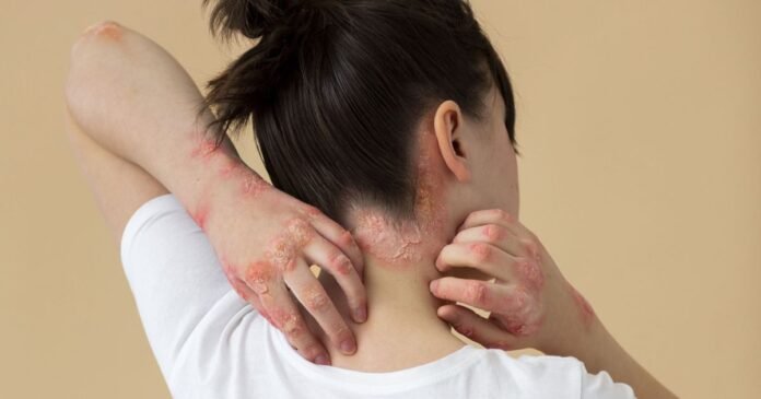 “Psoríase não é contagiosa”: médica alerta para impactos do preconceito