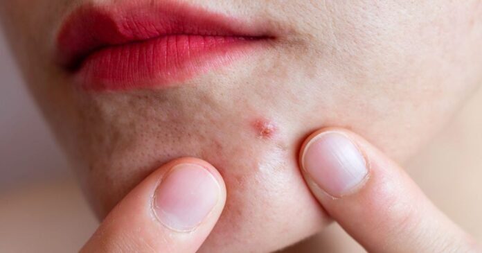 Estresse pode piorar acne e doenças de pele; veja dicas do que fazer
